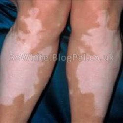 Lighten skin for Zambian people