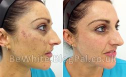 Skin lightening serum for Nigerian people