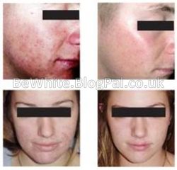 Bleach skin cream for Filipino men