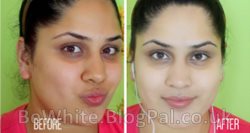Hyperpigmentation cream for Congo people