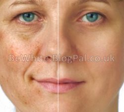 Acne cream for Zimbabwean people