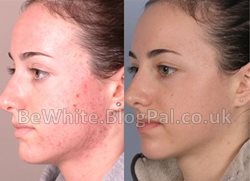 Skin lightening tips for Somalian