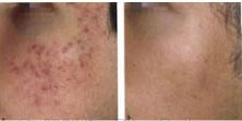 Hyperpigmentation cream for Malawian people