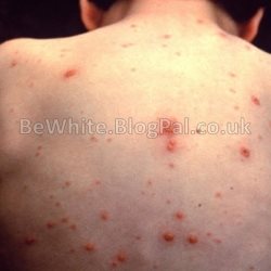 Skin whitening natural for Malawian people