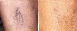 Lightening dark skin cream for Congolese women