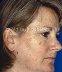 Whitening cream face for Jamaican women