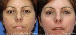 Bleaching face creams for Filipino woman