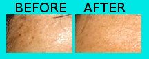 Facial whitening for Jamaican woman
