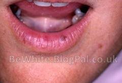 Facial whitening for Thai woman