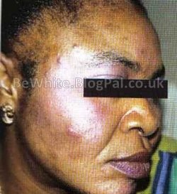 Bleaching skin creams for Malawi women