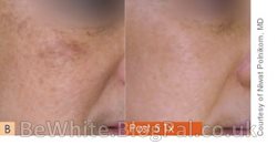 Face whitening creams for Africans