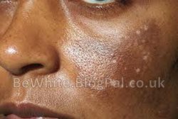 Most effective whitening cream for Congo