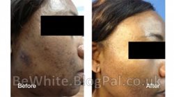 Body skin whitening for Malawian women