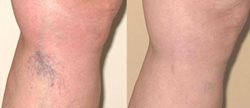 Bleach skin cream for Zambia women