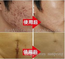 Asian whitening cream for Asian men