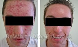 Dark spots remover cream for Jamaican people