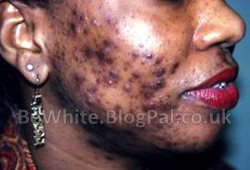 Whitening face cream for Zambia men