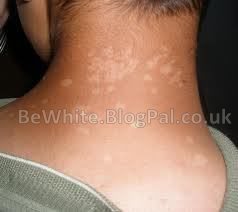 Skin lightening products for Malawi men
