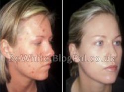 Whitening bleaching cream for Pakistani woman
