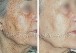 Face whitening for Nigerian woman