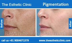 Whitening cream face for Somalian people