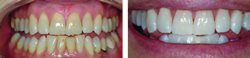 Whitening face creams for Africans woman
