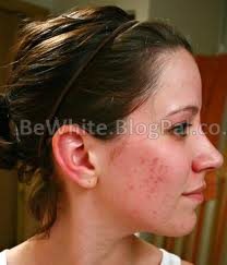 Skin bleaching products for Somali
