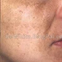 Best skin lightener for Uganda women