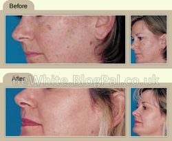 Lightening dark skin cream for Black Jamaican women