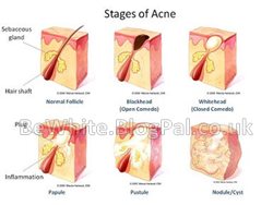 Kojic acid whitening cream for hand