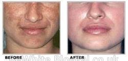 Hyperpigmentation creams for Somali