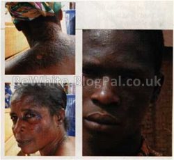 Bleaching your skin for Black Trinidadians people