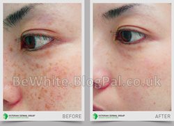 Dark spots remover cream for Somalia women