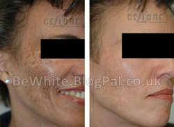 Brighten skin for Zambian