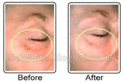 Bleach skin for Somali men