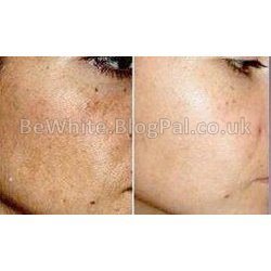 Bleaching neck creams for Somalia people