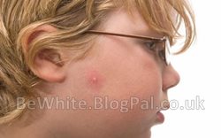 Pigmentation treatment for Zambia woman