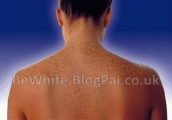 Skin whitening natural for Asian women