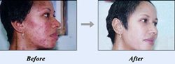 Bleach skin cream for Somali men