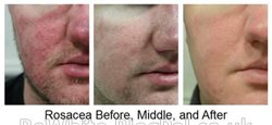 Skin lightening facial for Zimbabwe women