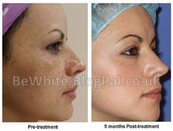 Whiten face for Congolese