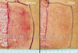 The best skin whitening cream for Malaysian