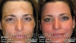 Best skin whitening cream in the world for Malawi men