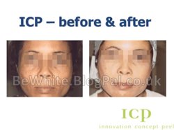 Bleaching skin cream