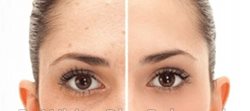 Skin bleaching for Indian woman