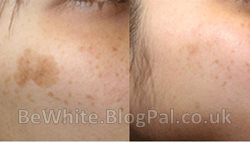 Facial whitening for Somali men