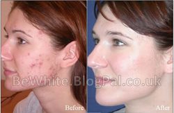 Pigmentation treatment for Congolese woman