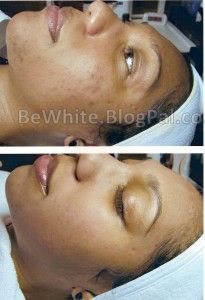 Best skin bleaching for Congolese people