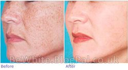 Face whitening products for South African woman
