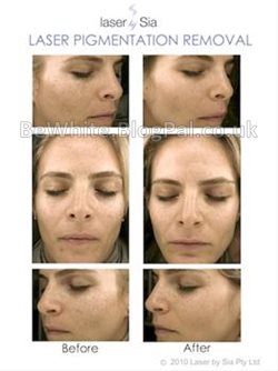 Skin whitening treatment for Black Africans women